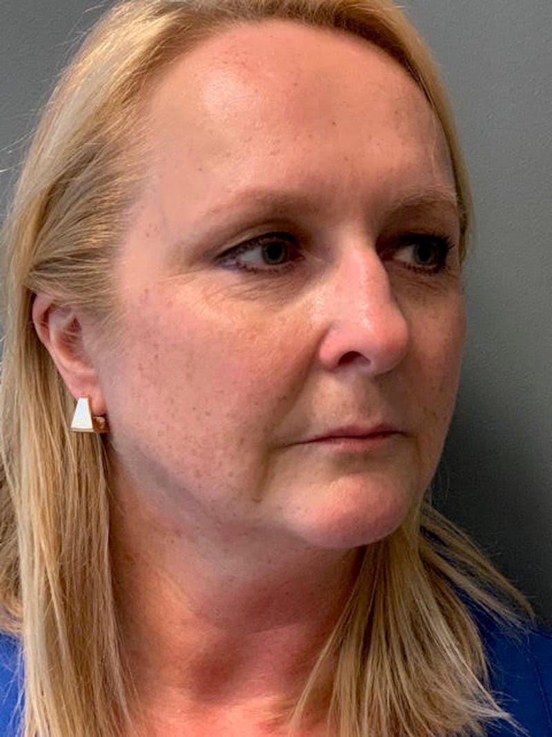 Neck Lift Before & After Gallery - Patient 400446 - Image 3