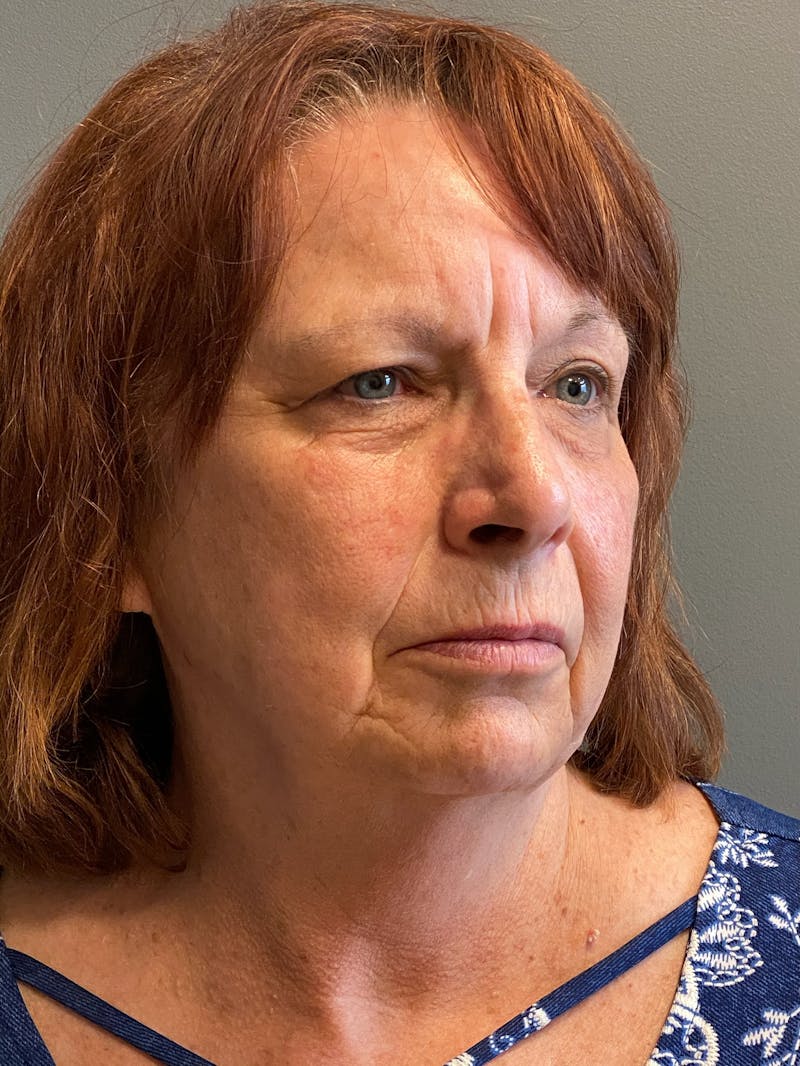 Deep Plane Facelift Before & After Gallery - Patient 273208 - Image 3