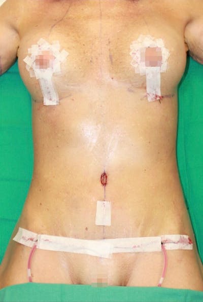 High Definition Mommy Makeover Before & After Gallery - Patient 253915 - Image 2