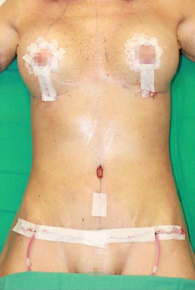 High Definition Mommy Makeover Before & After Gallery - Patient 253915 - Image 2