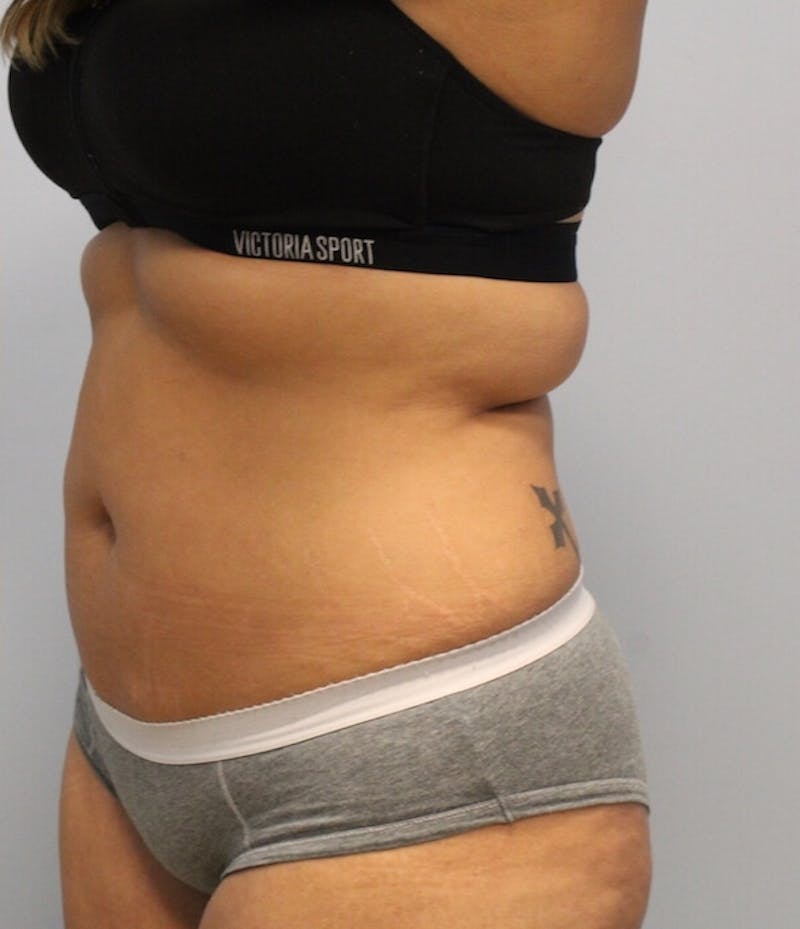 Fat Reduction (Non-Invasive) Before & After Gallery - Patient 263359 - Image 4