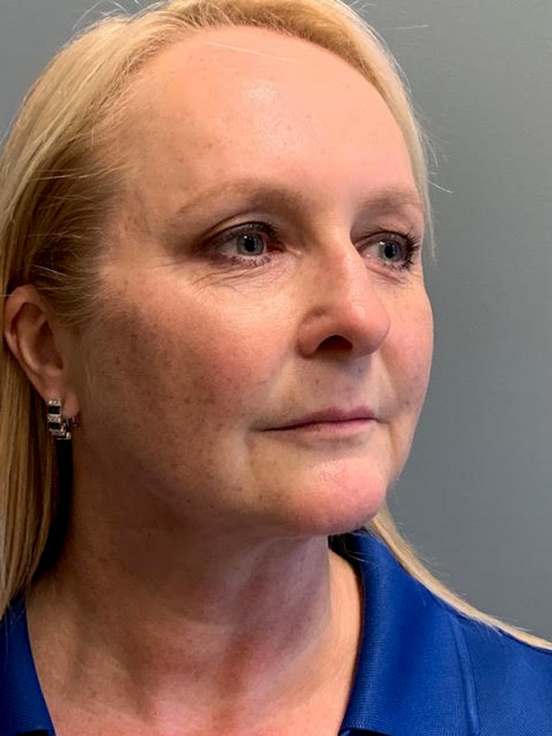 Neck Lift Before & After Gallery - Patient 400446 - Image 4