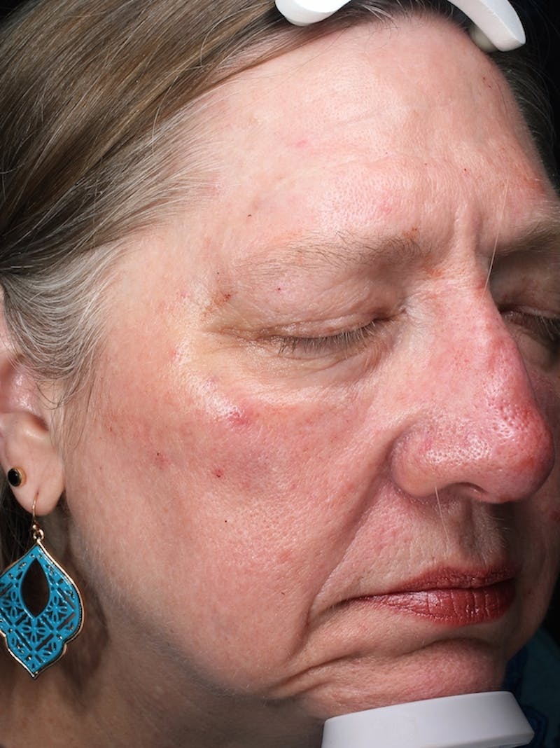 Lasers & Light Before & After Gallery - Patient 421204 - Image 3