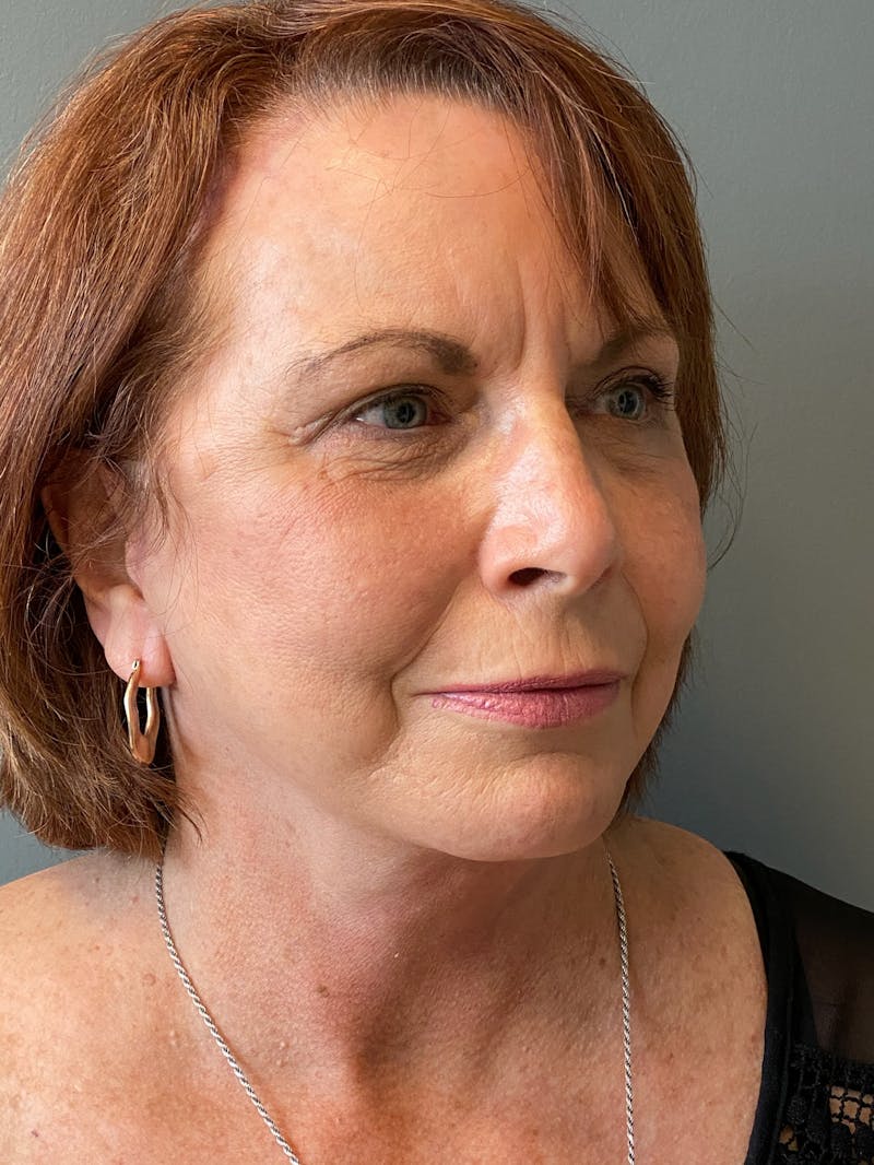 Deep Plane Facelift Before & After Gallery - Patient 273208 - Image 4