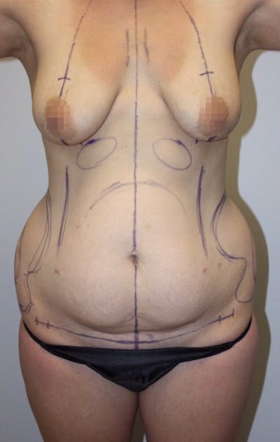 High Definition Mommy Makeover Before & After Gallery - Patient 285339 - Image 1