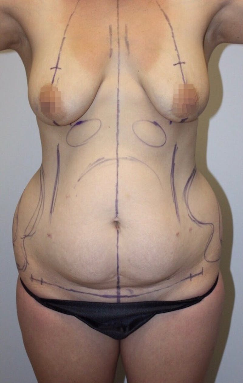 High Definition Mommy Makeover Before & After Gallery - Patient 285339 - Image 1