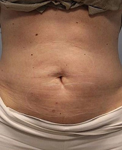 Fat Reduction (Non-Invasive) Before & After Gallery - Patient 353485 - Image 1