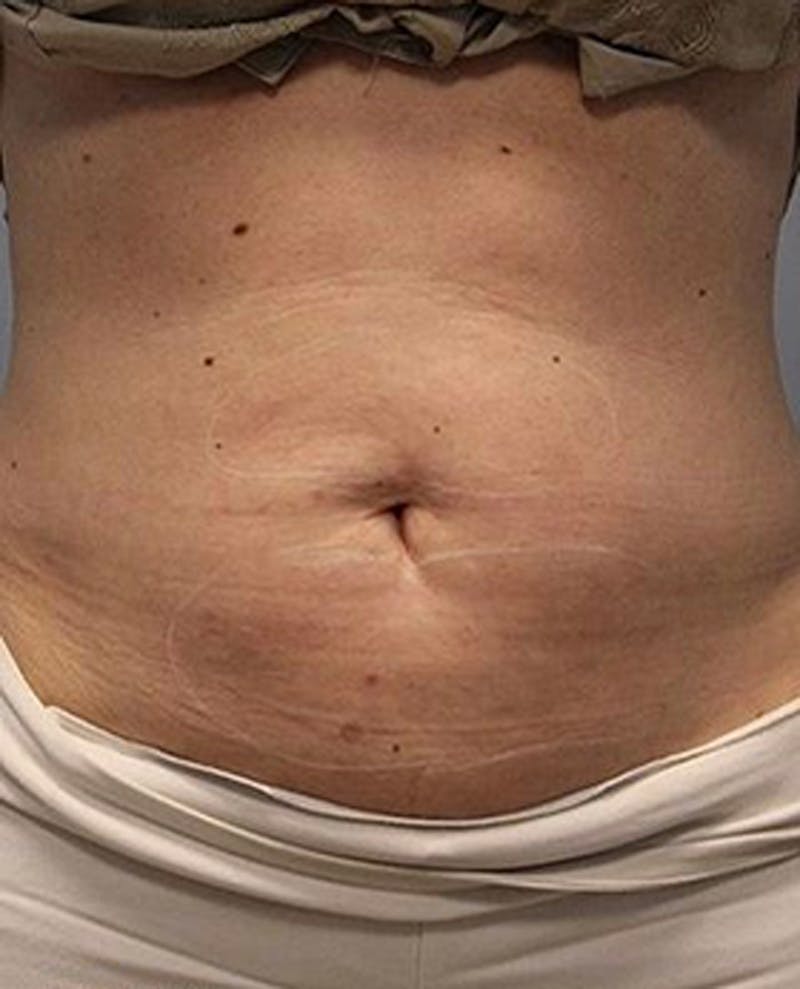 Fat Reduction (Non-Invasive) Before & After Gallery - Patient 353485 - Image 1