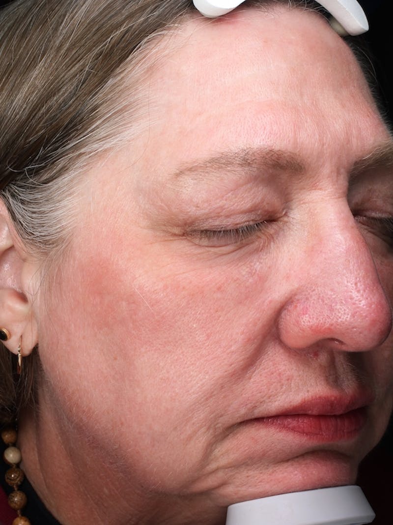 Lasers & Light Before & After Gallery - Patient 421204 - Image 4