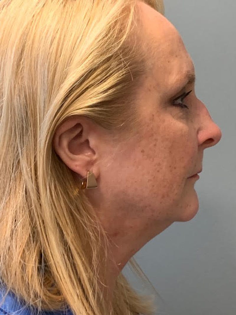 Neck Lift Before & After Gallery - Patient 400446 - Image 5