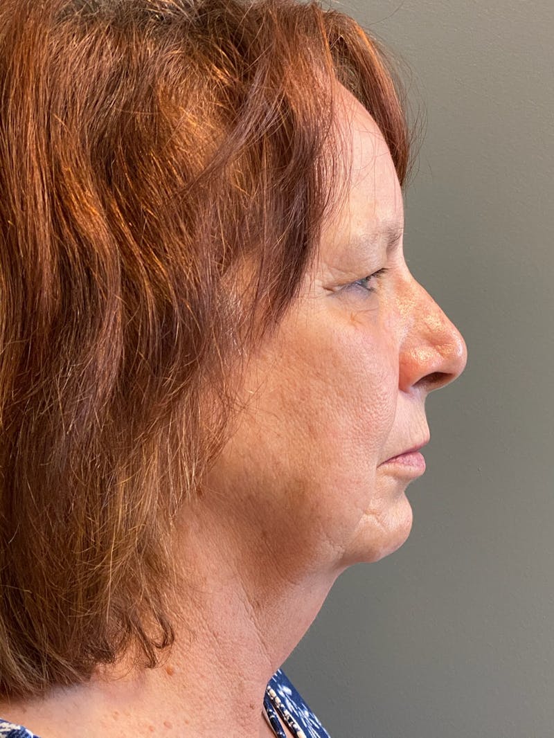 Deep Plane Facelift Before & After Gallery - Patient 273208 - Image 5