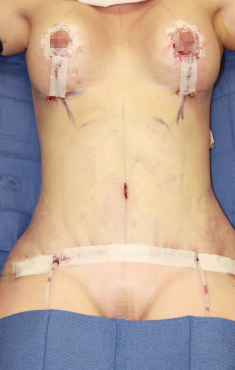High Definition Mommy Makeover Before & After Gallery - Patient 285339 - Image 2
