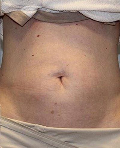 Fat Reduction (Non-Invasive) Before & After Gallery - Patient 353485 - Image 2
