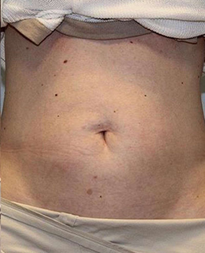 Fat Reduction (Non-Invasive) Before & After Gallery - Patient 353485 - Image 2