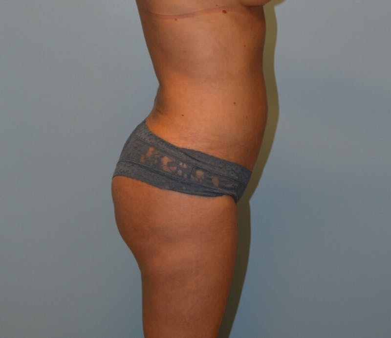Tummy Tuck Before & After Gallery - Patient 253662 - Image 6