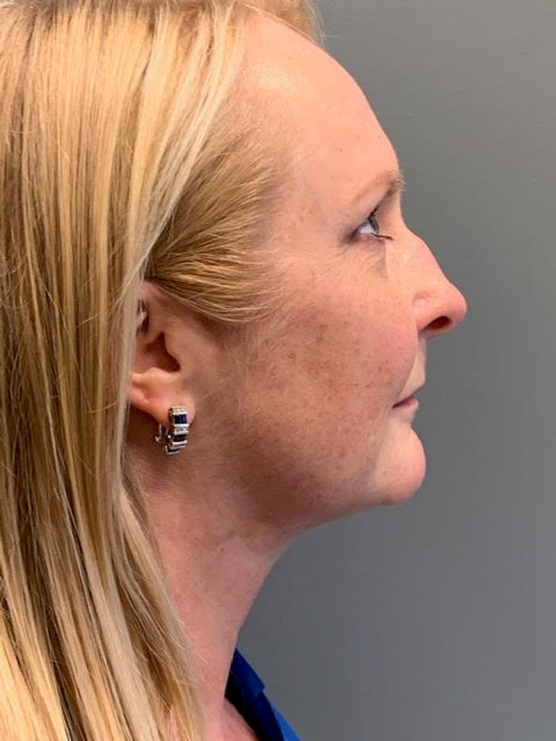 Neck Lift Before & After Gallery - Patient 400446 - Image 6
