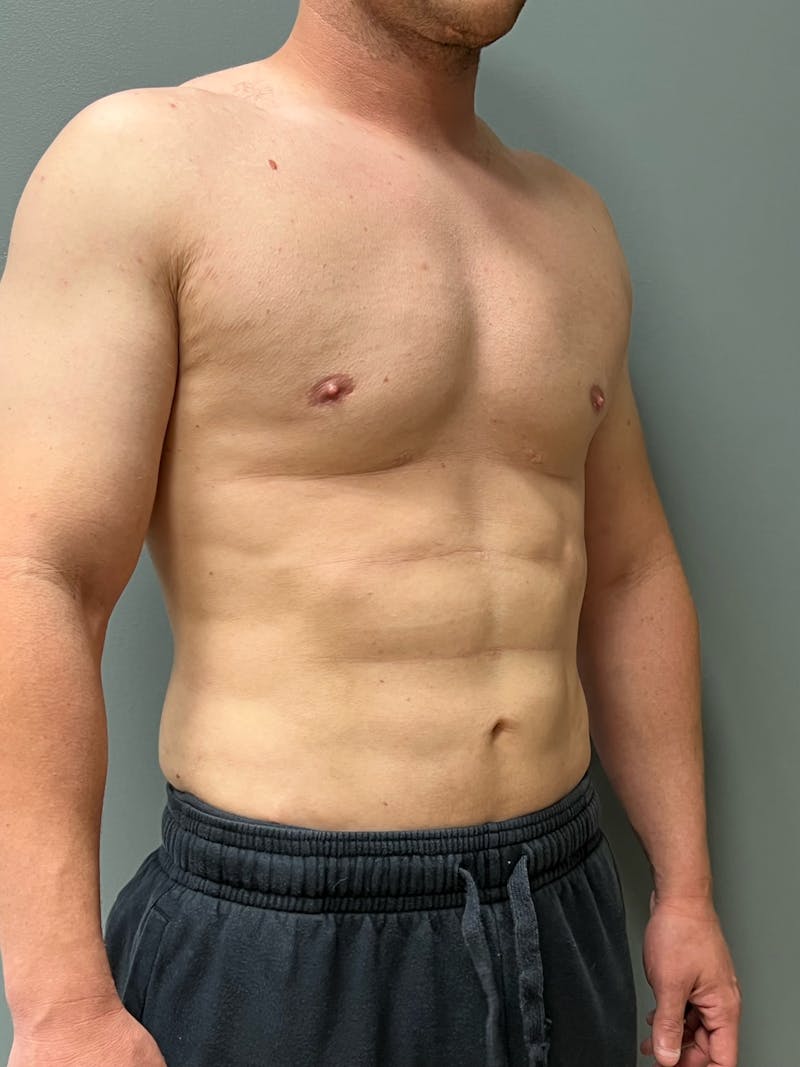 Hi Def Liposuction Before & After Gallery - Patient 288494 - Image 4