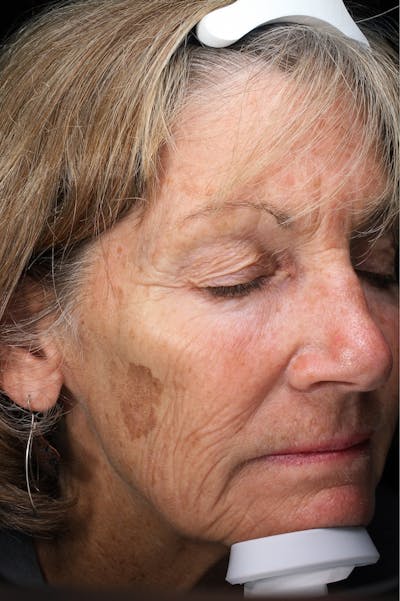 Lasers & Light Before & After Gallery - Patient 355358 - Image 1