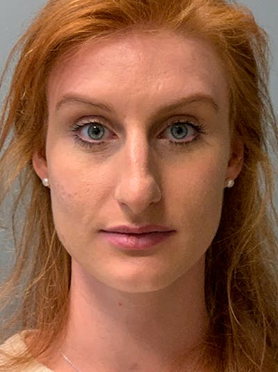 Rhinoplasty Before & After Gallery - Patient 214328 - Image 1
