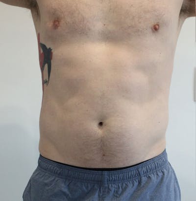 Fat Reduction (Non-Invasive) Before & After Gallery - Patient 290874 - Image 1