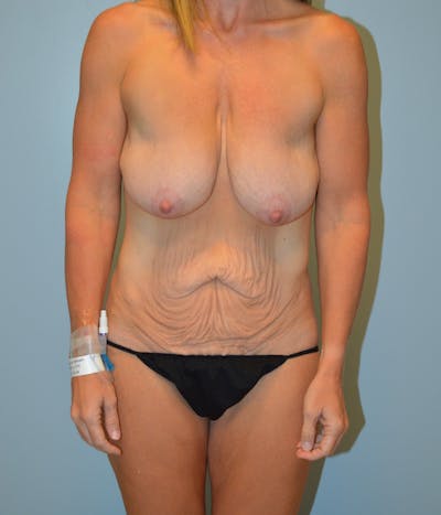 Tummy Tuck Before & After Gallery - Patient 167190 - Image 1