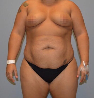 High Definition Mommy Makeover Before & After Gallery - Patient 380357 - Image 1