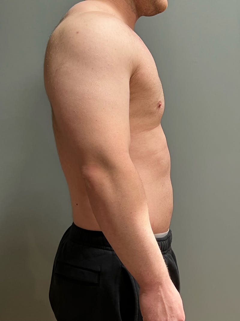 Hi Def Liposuction Before & After Gallery - Patient 288494 - Image 5