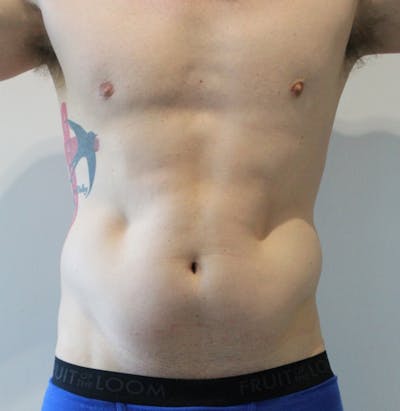 Fat Reduction (Non-Invasive) Before & After Gallery - Patient 290874 - Image 2