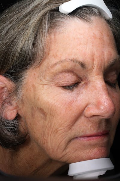 Lasers & Light Before & After Gallery - Patient 355358 - Image 2