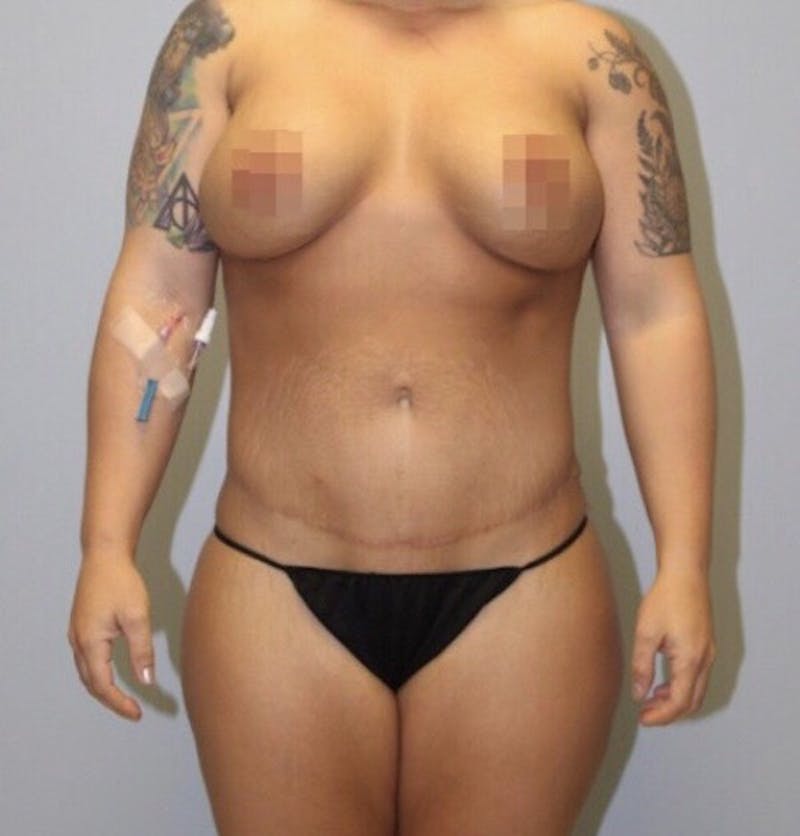 High Definition Mommy Makeover Before & After Gallery - Patient 380357 - Image 2