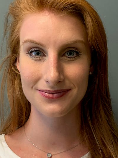 Rhinoplasty Before & After Gallery - Patient 214328 - Image 2