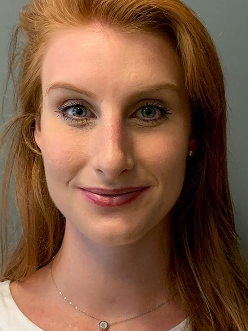 Rhinoplasty Before & After Gallery - Patient 214328 - Image 2