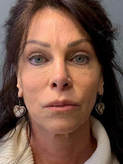 Deep Plane Facelift Before & After Gallery - Patient 333423 - Image 1