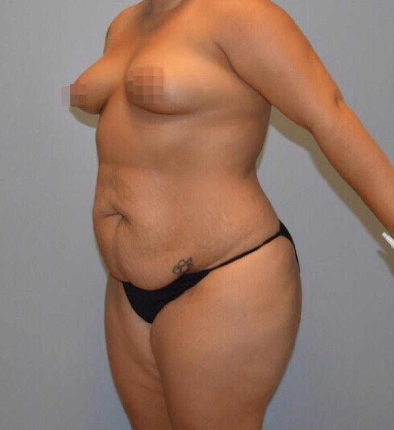 High Definition Mommy Makeover Before & After Gallery - Patient 380357 - Image 3