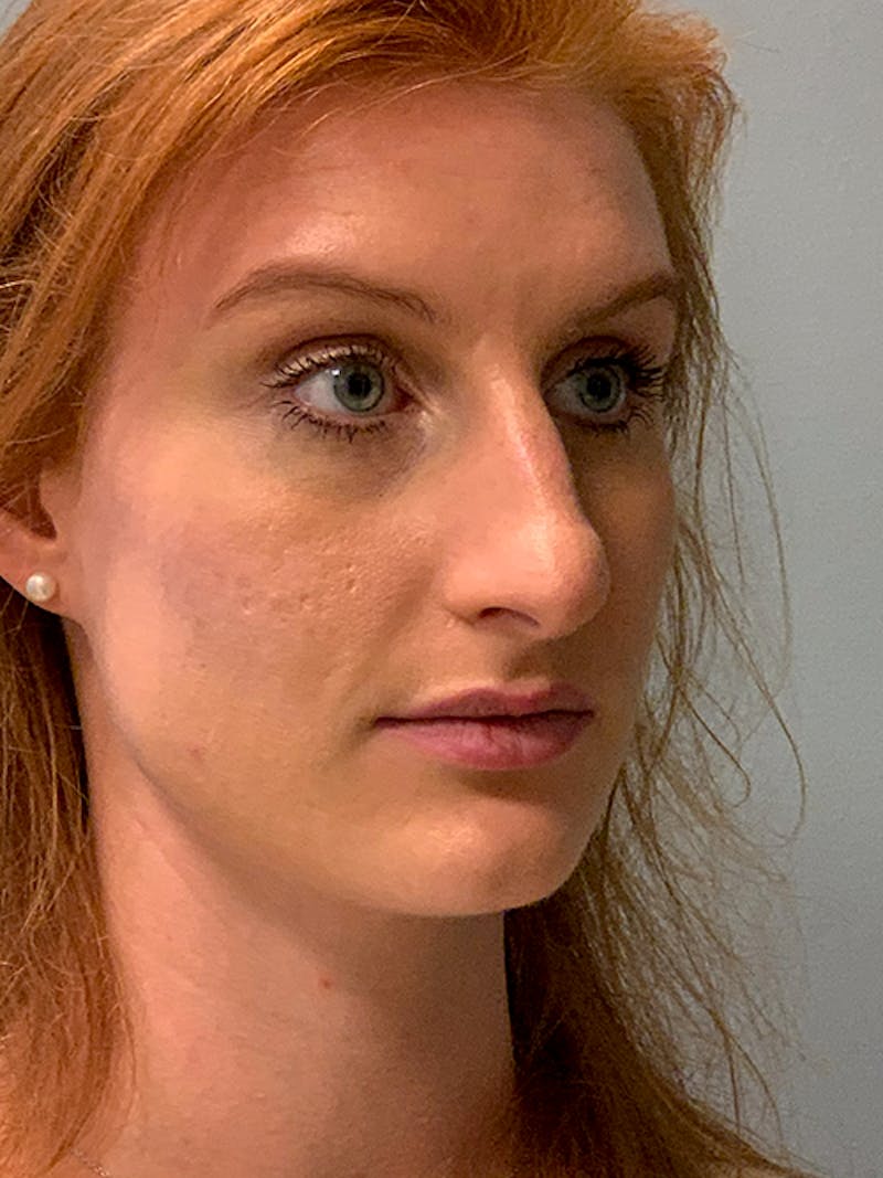 Rhinoplasty Before & After Gallery - Patient 214328 - Image 3