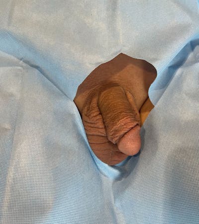 Penis Fillers Before & After Gallery - Patient 121112 - Image 1
