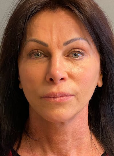 Deep Plane Facelift Before & After Gallery - Patient 333423 - Image 2