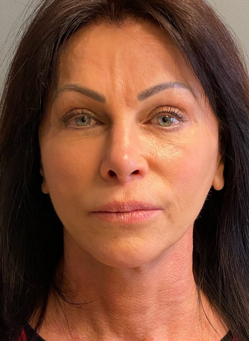 Deep Plane Facelift Before & After Gallery - Patient 333423 - Image 2