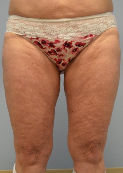 Fat Reduction (Non-Invasive) Before & After Gallery - Patient 209173 - Image 1