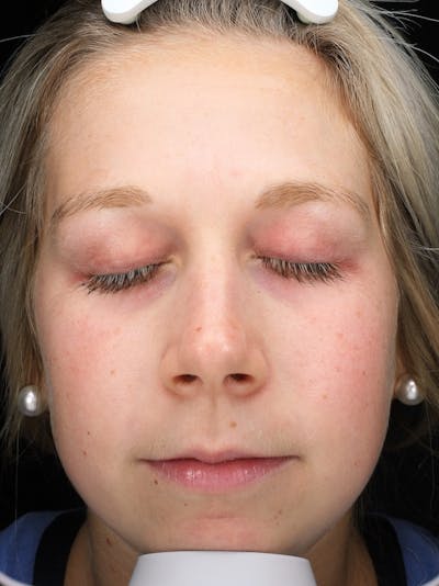 Lasers & Light Before & After Gallery - Patient 216774 - Image 1