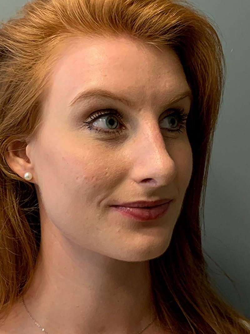 Rhinoplasty Before & After Gallery - Patient 214328 - Image 4