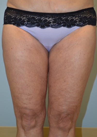 Fat Reduction (Non-Invasive) Before & After Gallery - Patient 209173 - Image 2