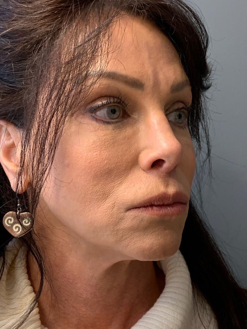 Deep Plane Facelift Before & After Gallery - Patient 333423 - Image 3