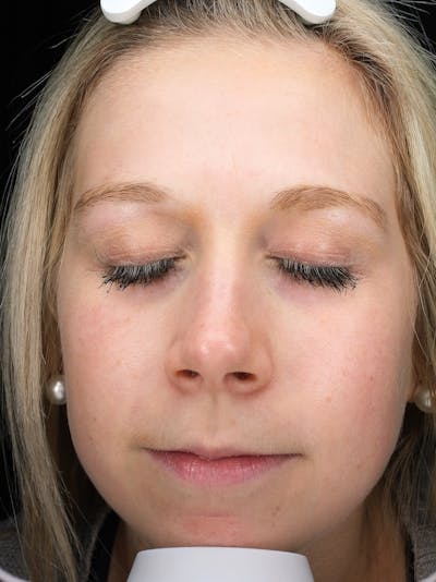 Lasers & Light Before & After Gallery - Patient 216774 - Image 2