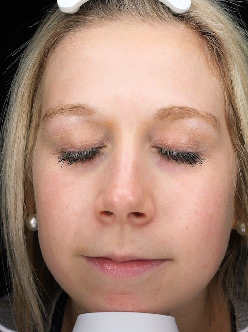 Lasers & Light Before & After Gallery - Patient 216774 - Image 2