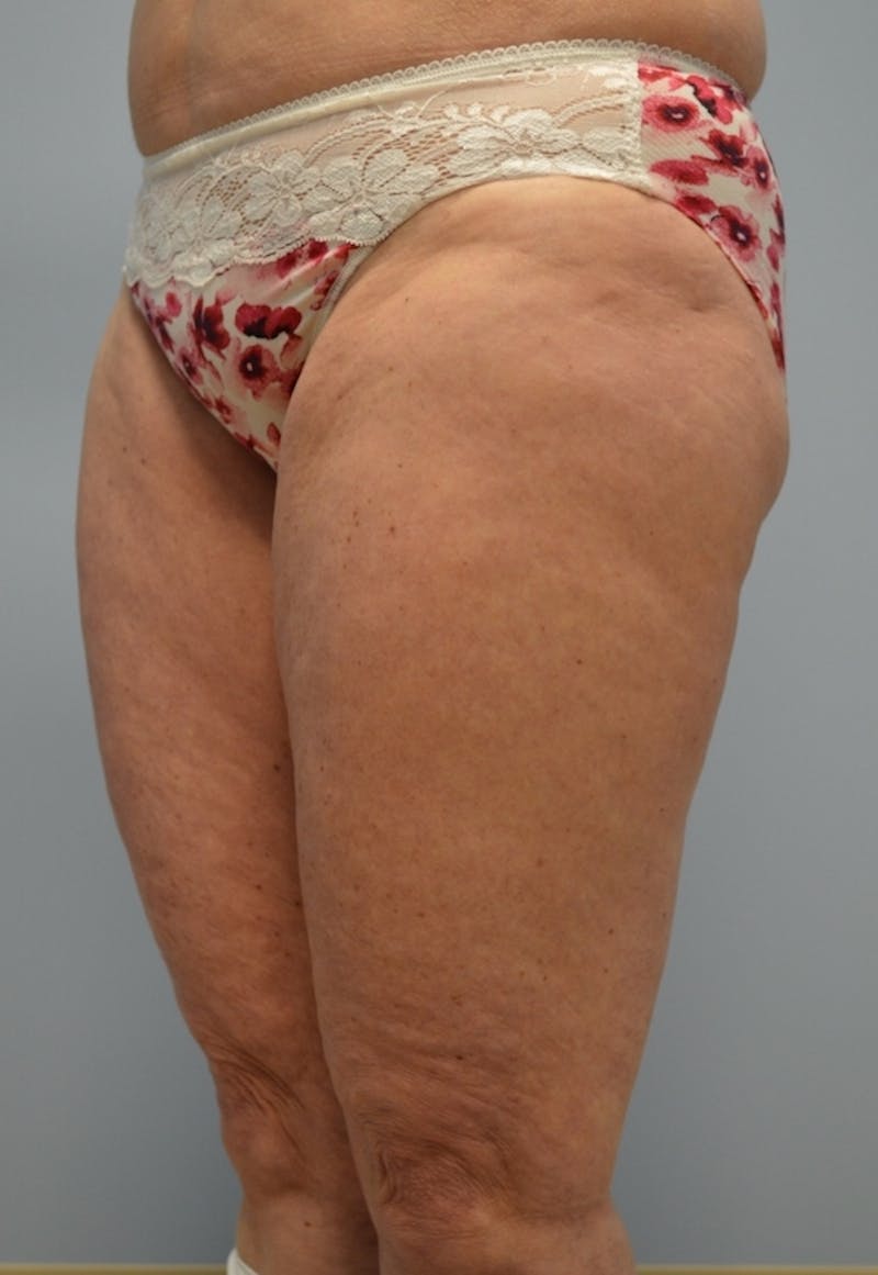 Fat Reduction (Non-Invasive) Before & After Gallery - Patient 209173 - Image 3