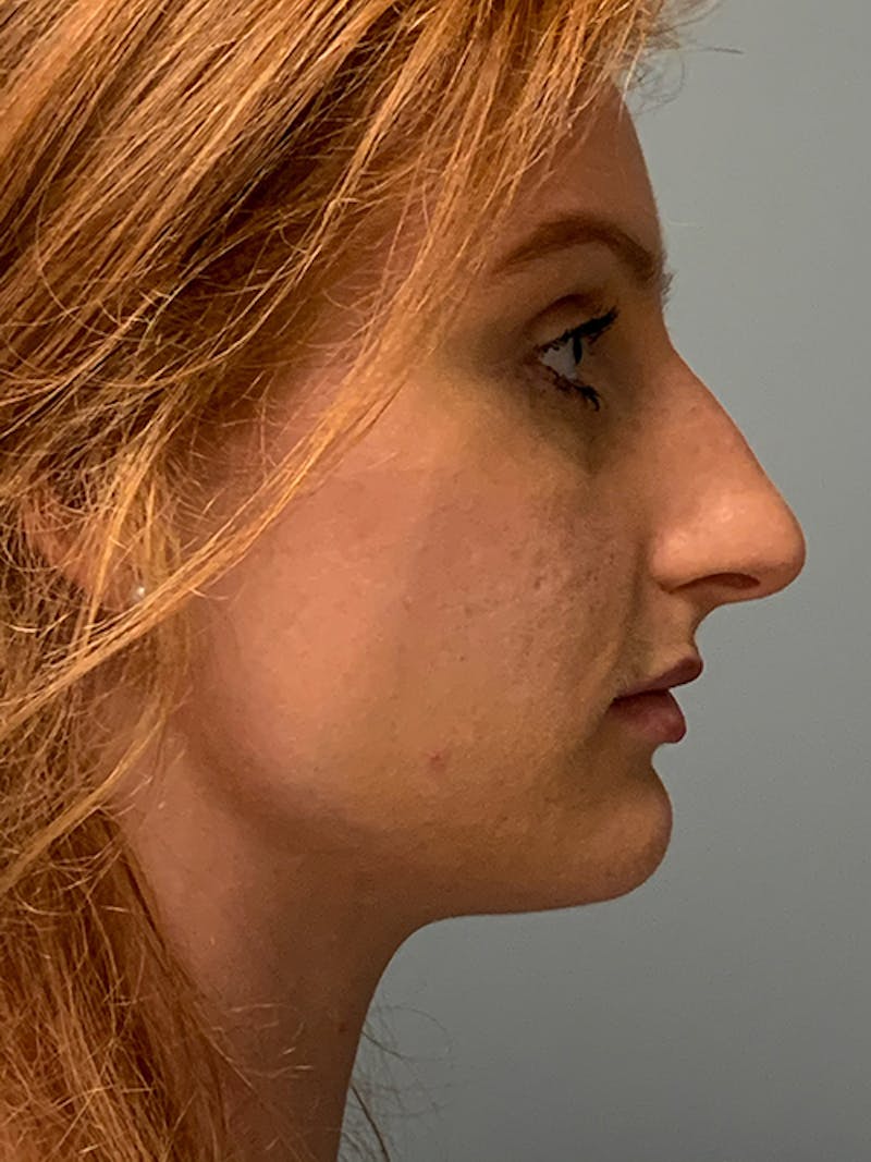 Rhinoplasty Before & After Gallery - Patient 214328 - Image 5