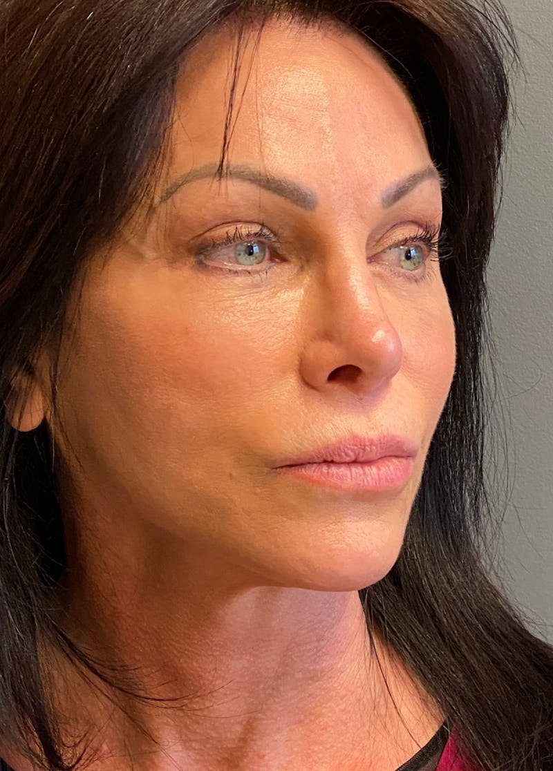 Deep Plane Facelift Before & After Gallery - Patient 333423 - Image 4