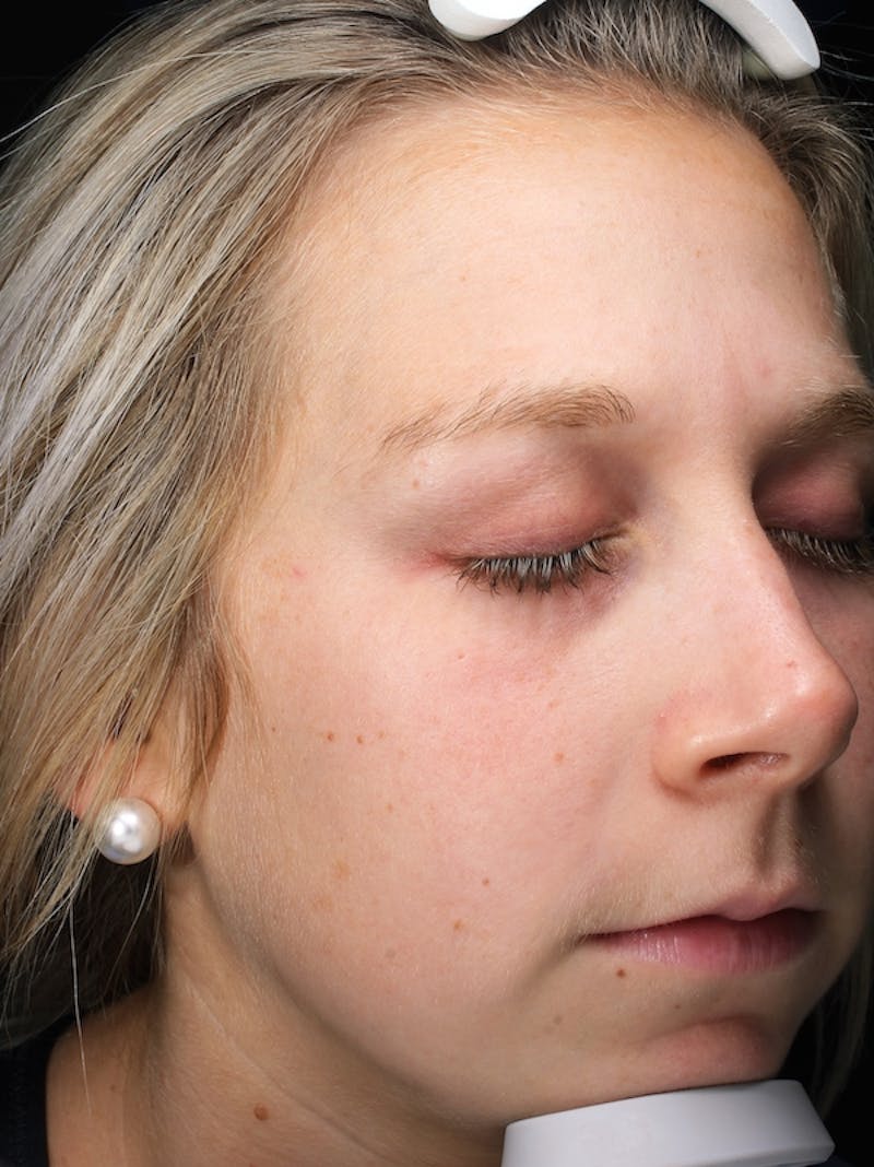 Lasers & Light Before & After Gallery - Patient 216774 - Image 3