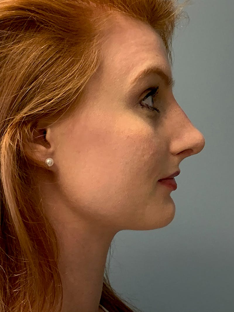 Rhinoplasty Before & After Gallery - Patient 214328 - Image 6